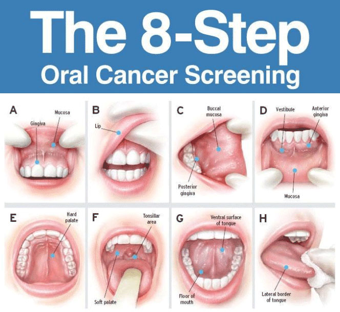 Oral Cancer